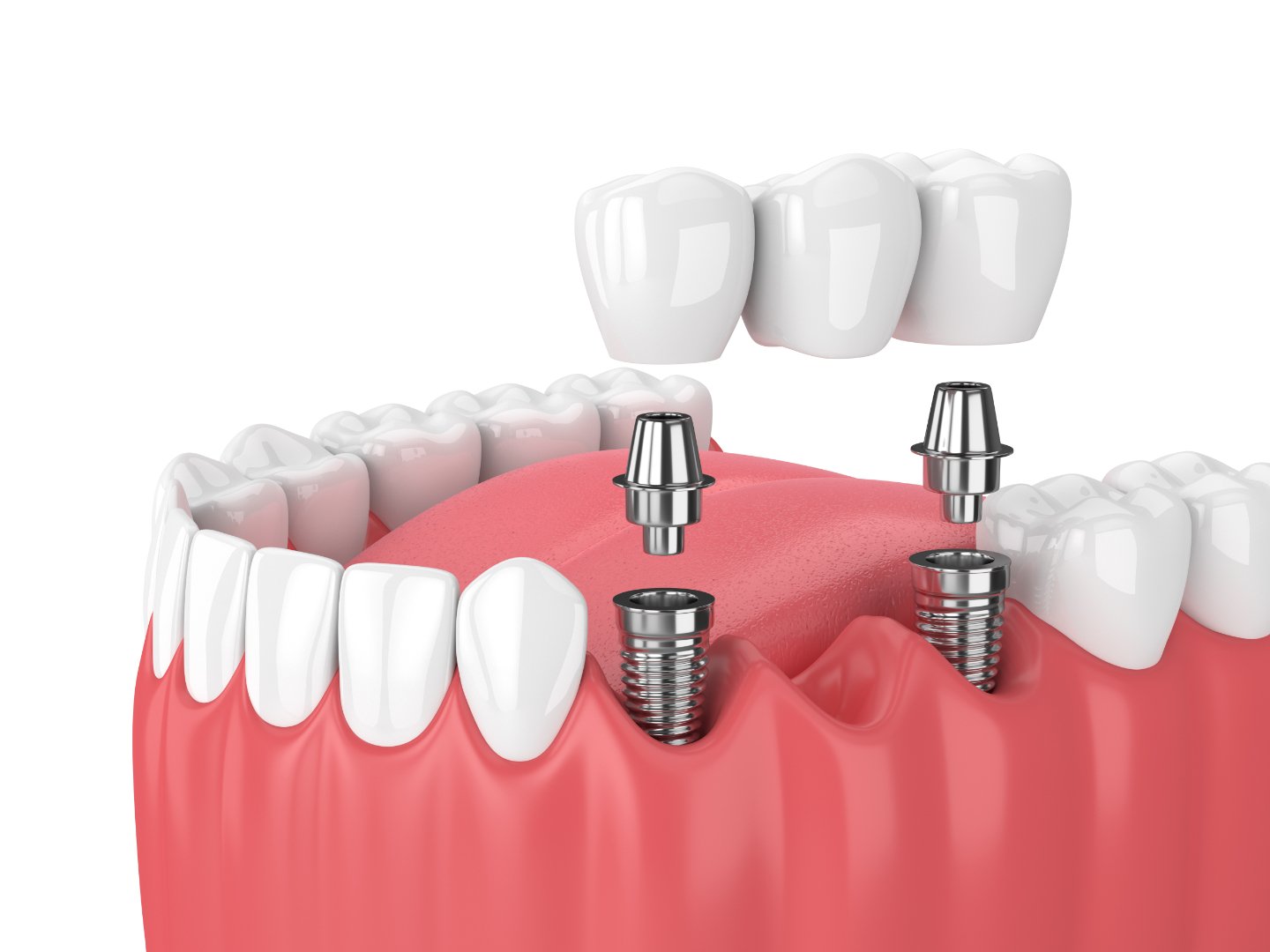 Dental Implants illustration