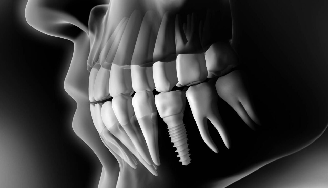 Implant smile result