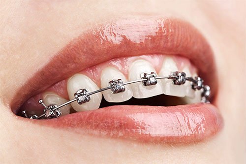 Orthodontic braces