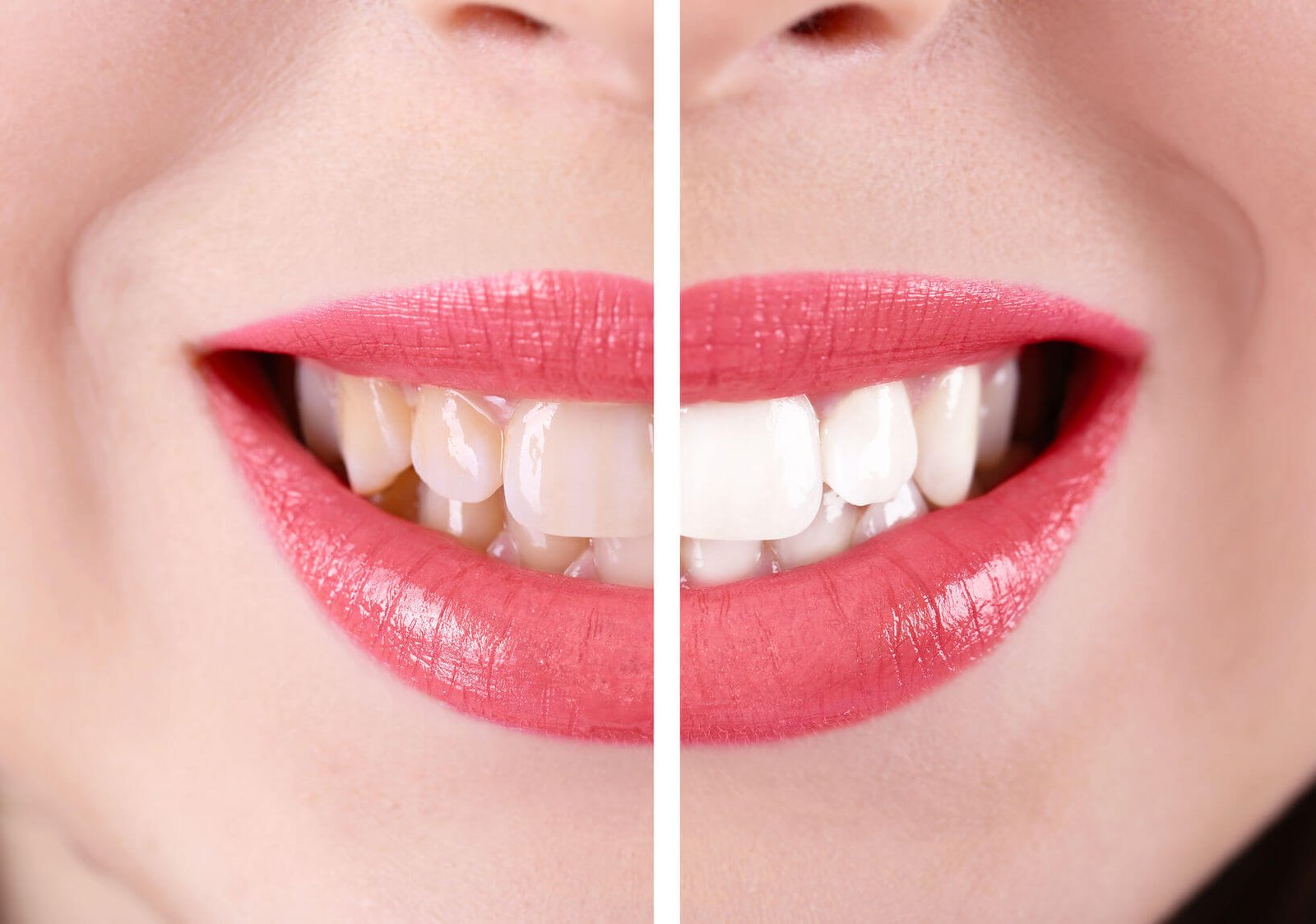 Teeth Whitening process